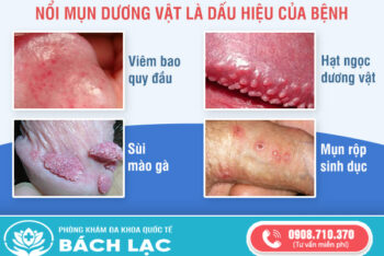 Khám Nổi Mụn Dương Vật Ở Đâu Đắk Lắk? Địa Chỉ Khám Chữa Dương Vật Nổi Mụn Hiệu Quả Tại Đắk Lắk