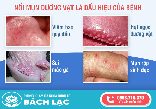 nổi mụn dương vật là bệnh gì